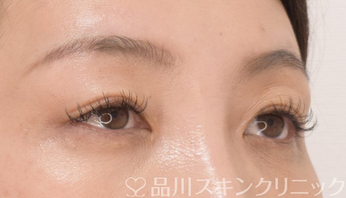症例NO.70234のAFTER写真