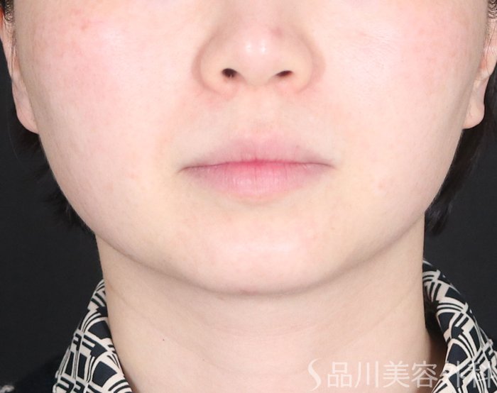 症例NO.73858のBEFORE写真
