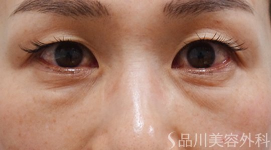 症例NO.70888のBEFORE写真