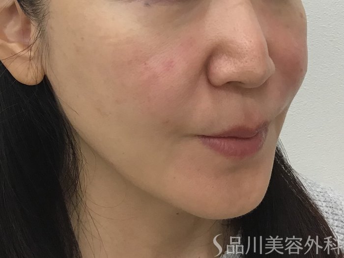 症例NO.62261のAFTER写真