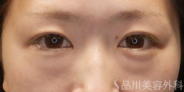 症例NO.74060のBEFORE写真