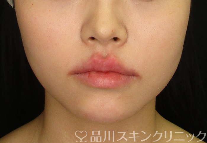 症例NO.70211のAFTER写真