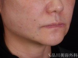 症例NO.72353のAFTER写真