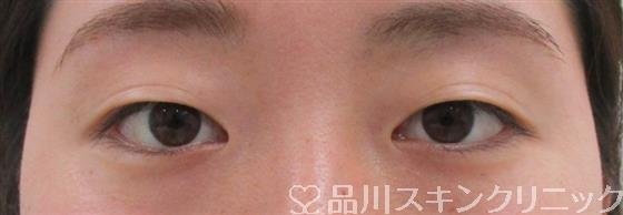 症例NO.43215のBEFORE写真