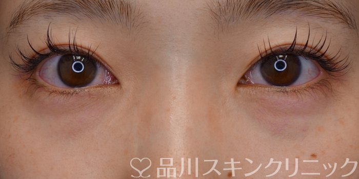 症例NO.72532のBEFORE写真