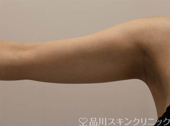 症例NO.46903のBEFORE写真