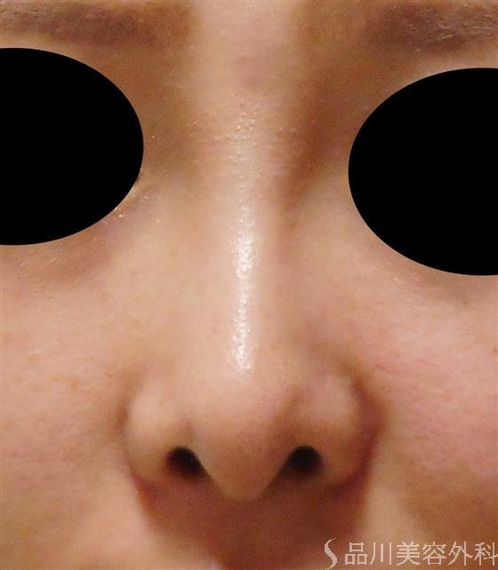 症例NO.37423のAFTER写真