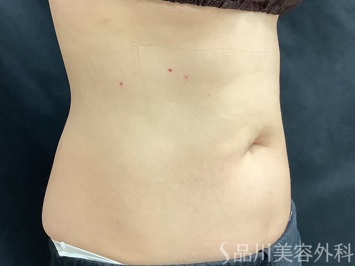 症例NO.75342のBEFORE写真
