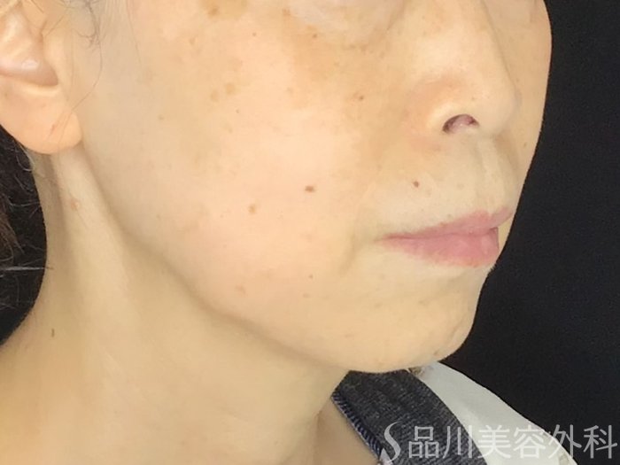 症例NO.67606のBEFORE写真