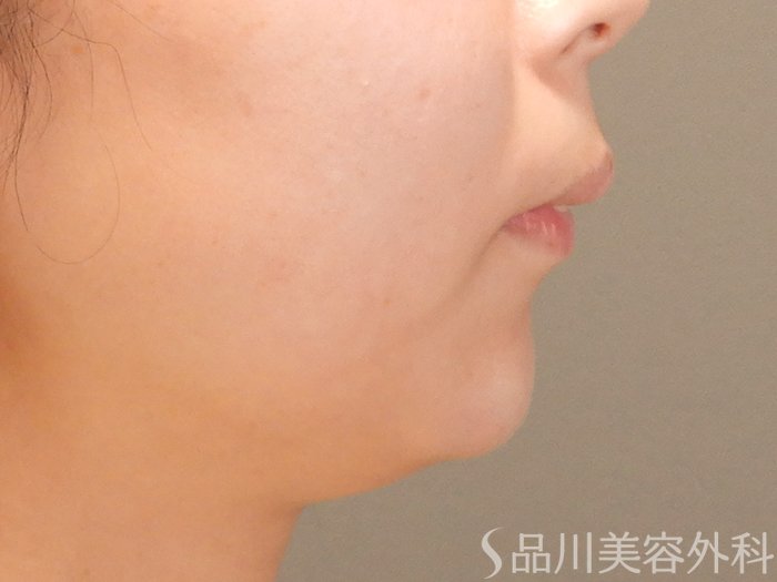 症例NO.69730のAFTER写真