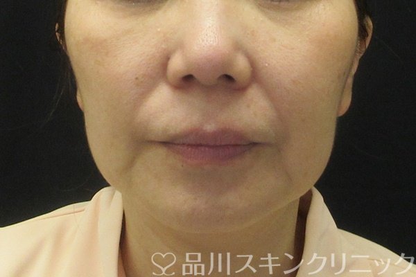 症例NO.65514のBEFORE写真