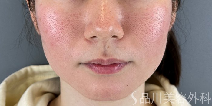 症例NO.73008のBEFORE写真