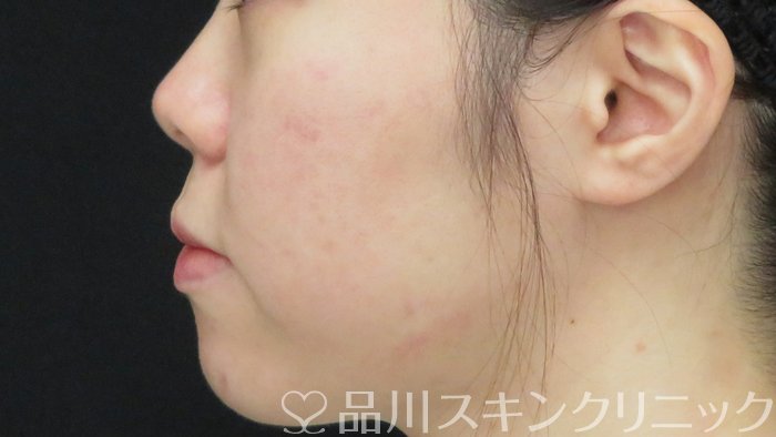 症例NO.71428のBEFORE写真