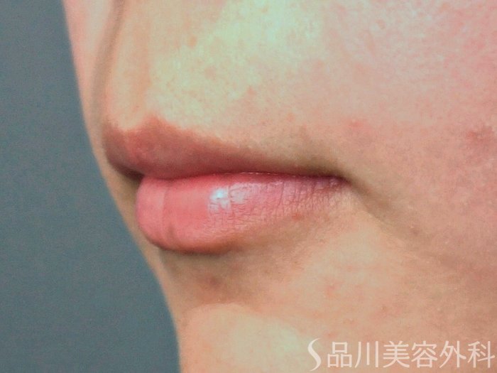 症例NO.73922のBEFORE写真