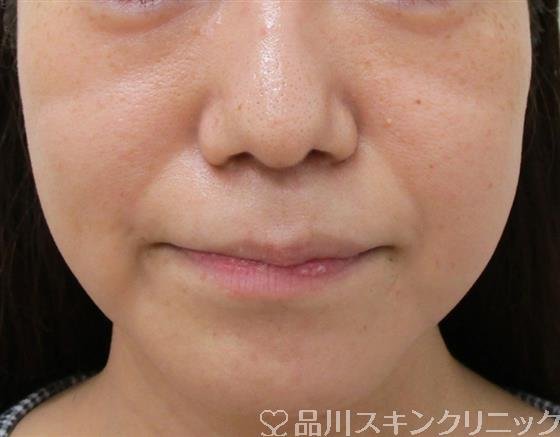 症例NO.37718のBEFORE写真
