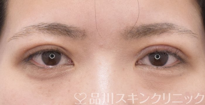 症例NO.71183のAFTER写真