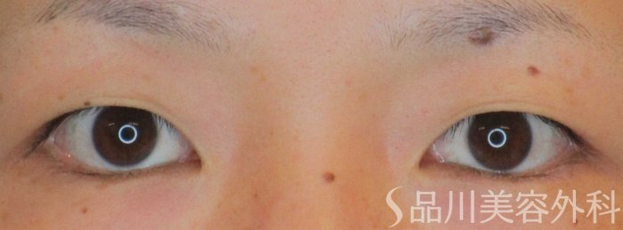 症例NO.64746のBEFORE写真