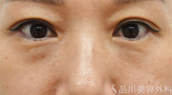 症例NO.46605のBEFORE写真