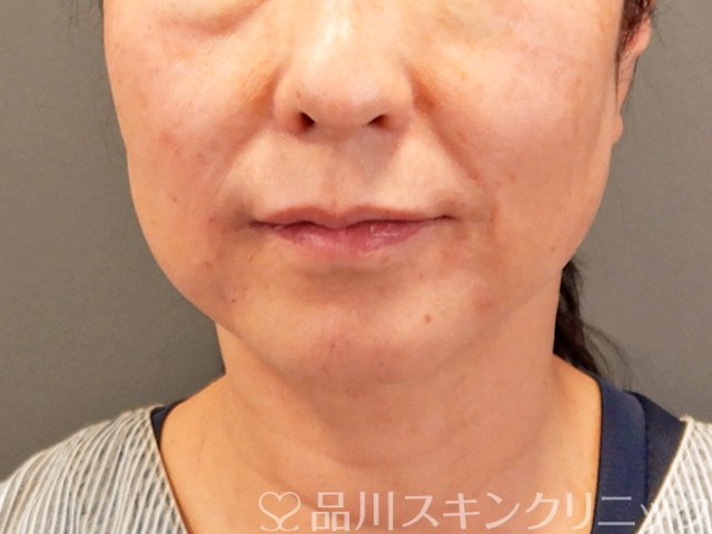 症例NO.70433のAFTER写真