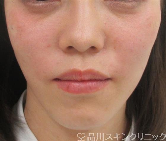 症例NO.29709のAFTER写真