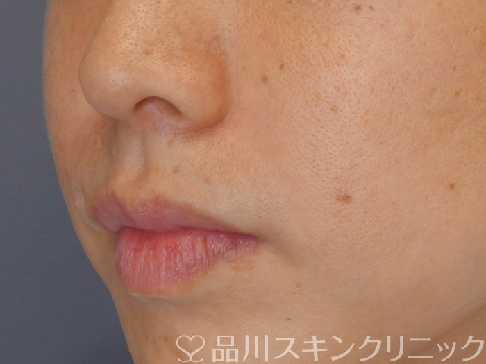 症例NO.72120のAFTER写真