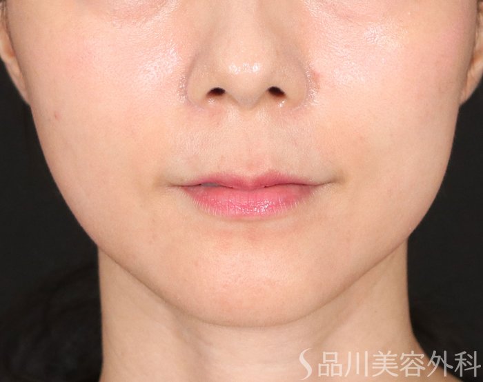 症例NO.71635のBEFORE写真