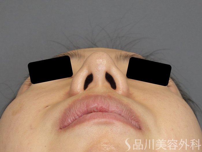 症例NO.74328のAFTER写真