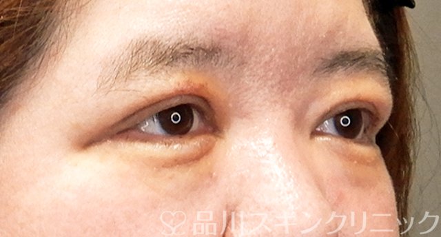 症例NO.64419のAFTER写真