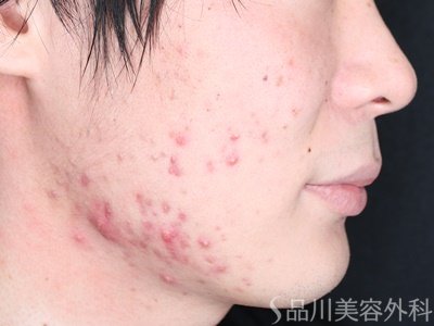 症例NO.74563のBEFORE写真