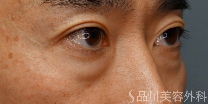 症例NO.73163のBEFORE写真