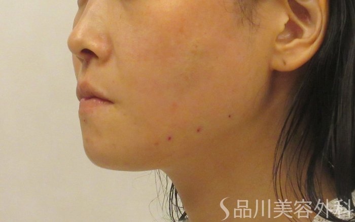 症例NO.71876のAFTER写真