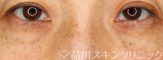 症例NO.70420のAFTER写真