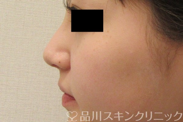 症例NO.69564のAFTER写真