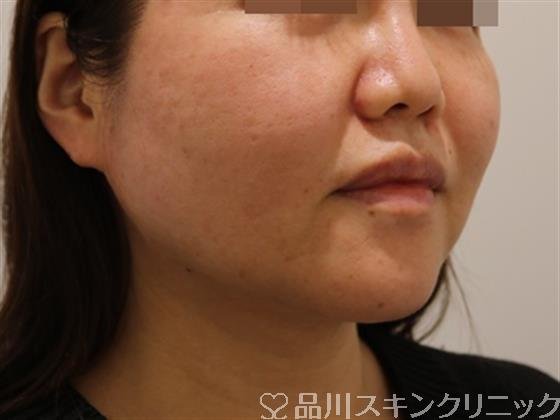 症例NO.44327のAFTER写真