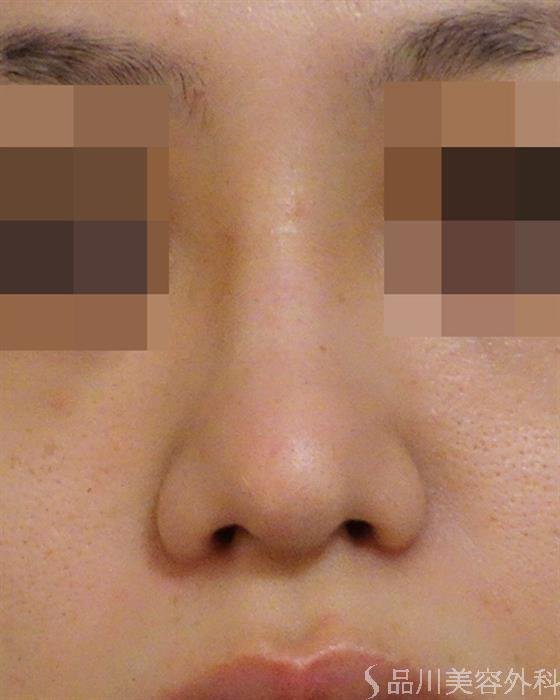 症例NO.42764のAFTER写真