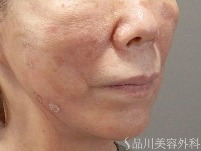 症例NO.71712のAFTER写真