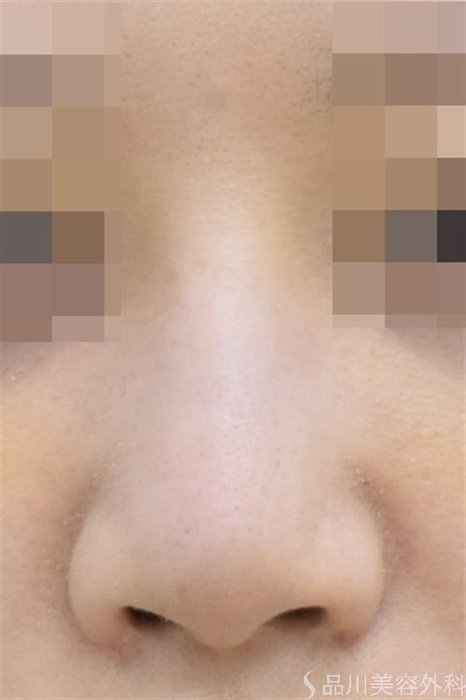 症例NO.42880のAFTER写真