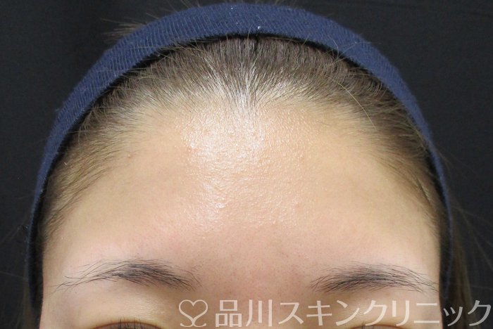 症例NO.65015のBEFORE写真