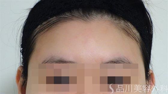 症例NO.46679のAFTER写真