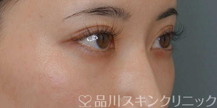症例NO.74048のAFTER写真