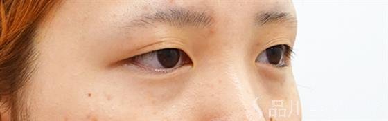 症例NO.48903のBEFORE写真