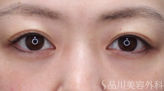 症例NO.74047のBEFORE写真