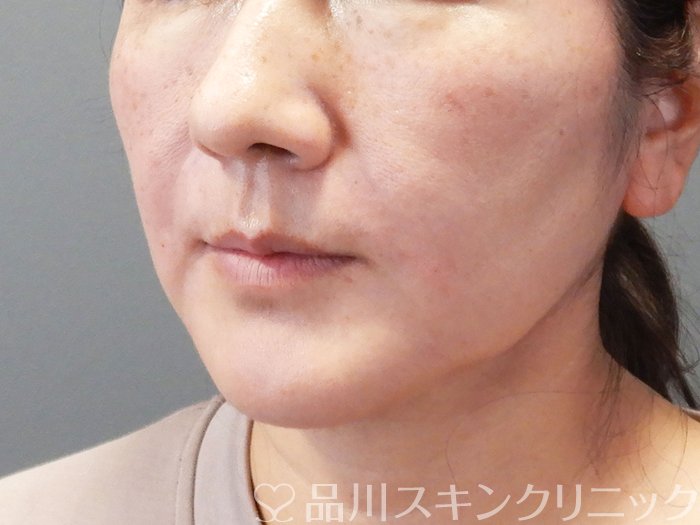 症例NO.74189のAFTER写真