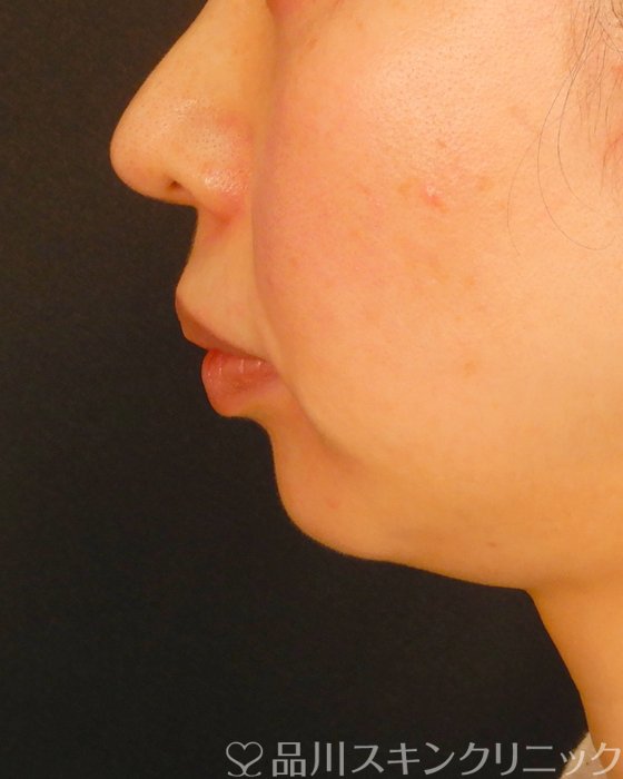 症例NO.66886のBEFORE写真