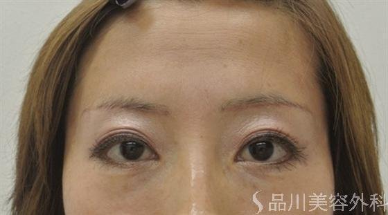 症例NO.16022のAFTER写真