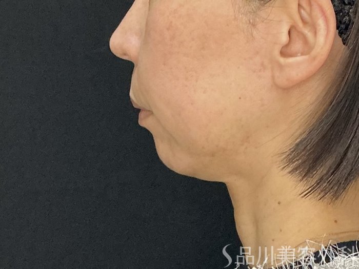 症例NO.72573のBEFORE写真