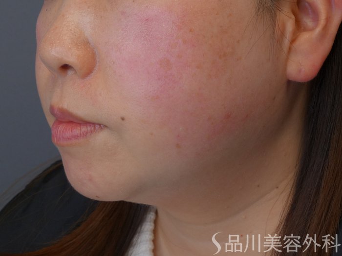 症例NO.73473のBEFORE写真