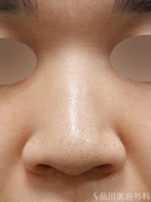 症例NO.69600のBEFORE写真