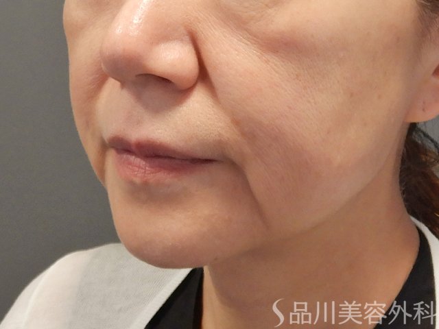 症例NO.72211のBEFORE写真