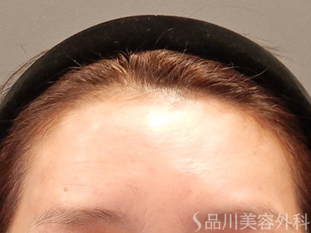 症例NO.73970のAFTER写真